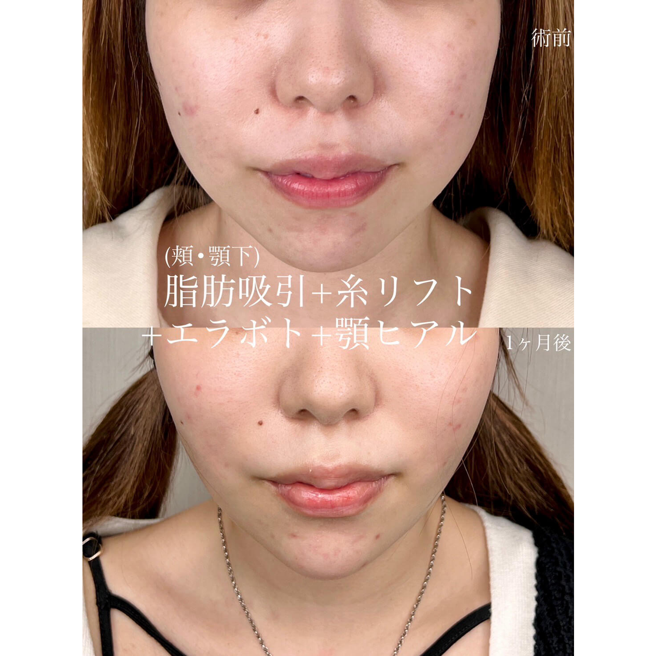 小顔 症例04