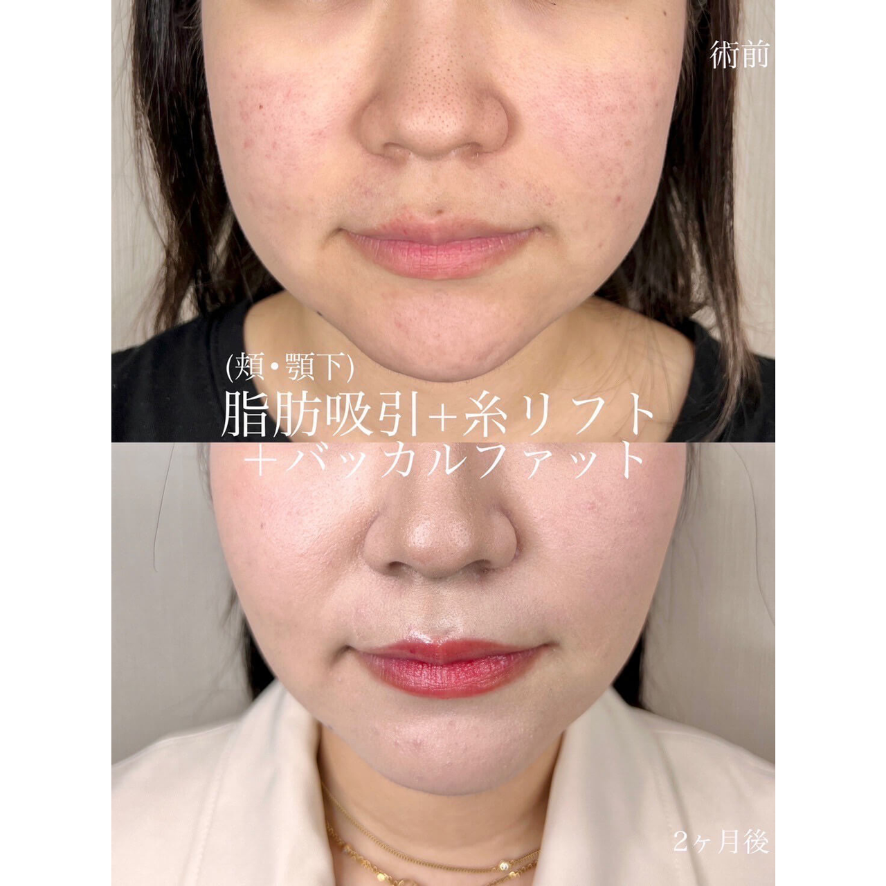 小顔 症例07
