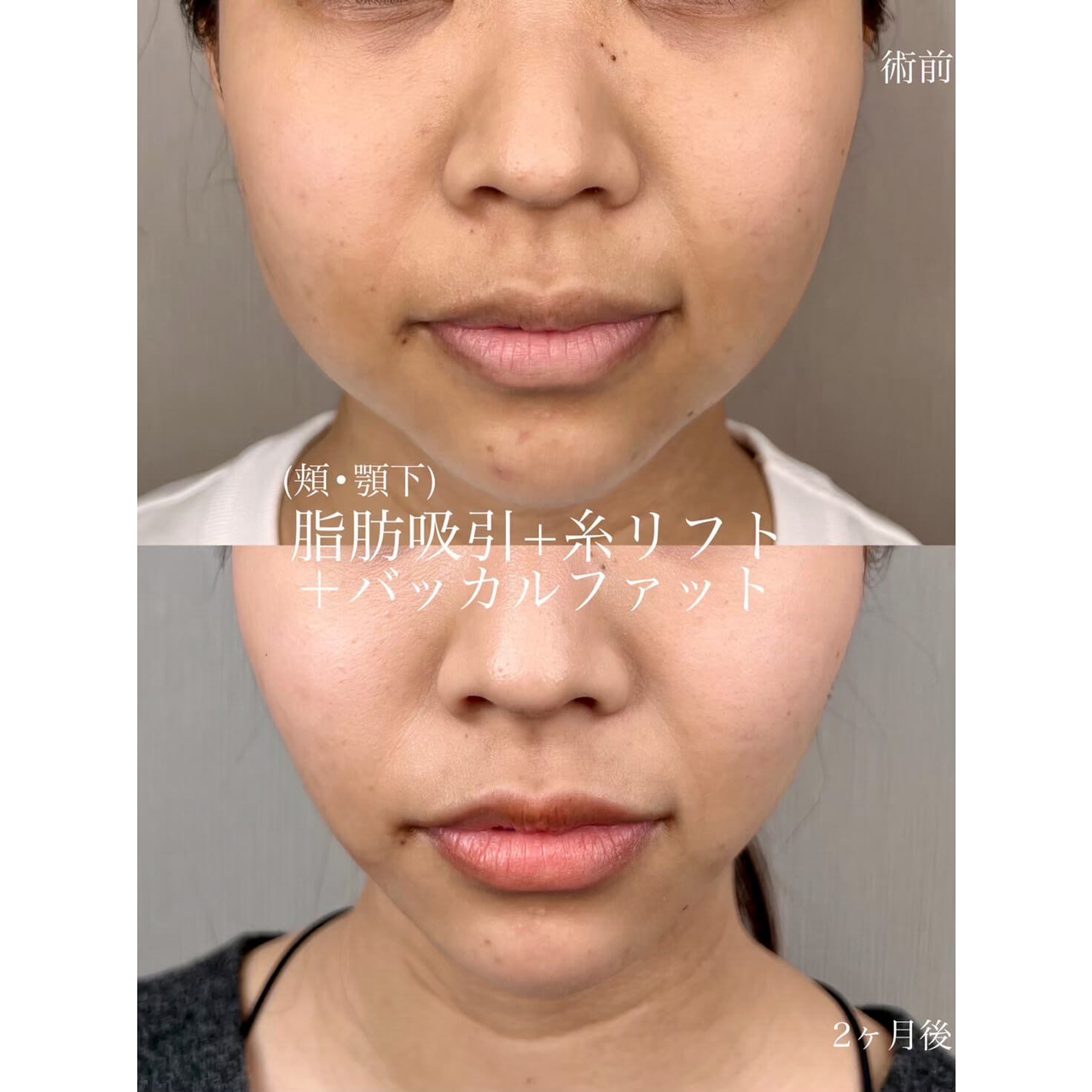 小顔 症例09