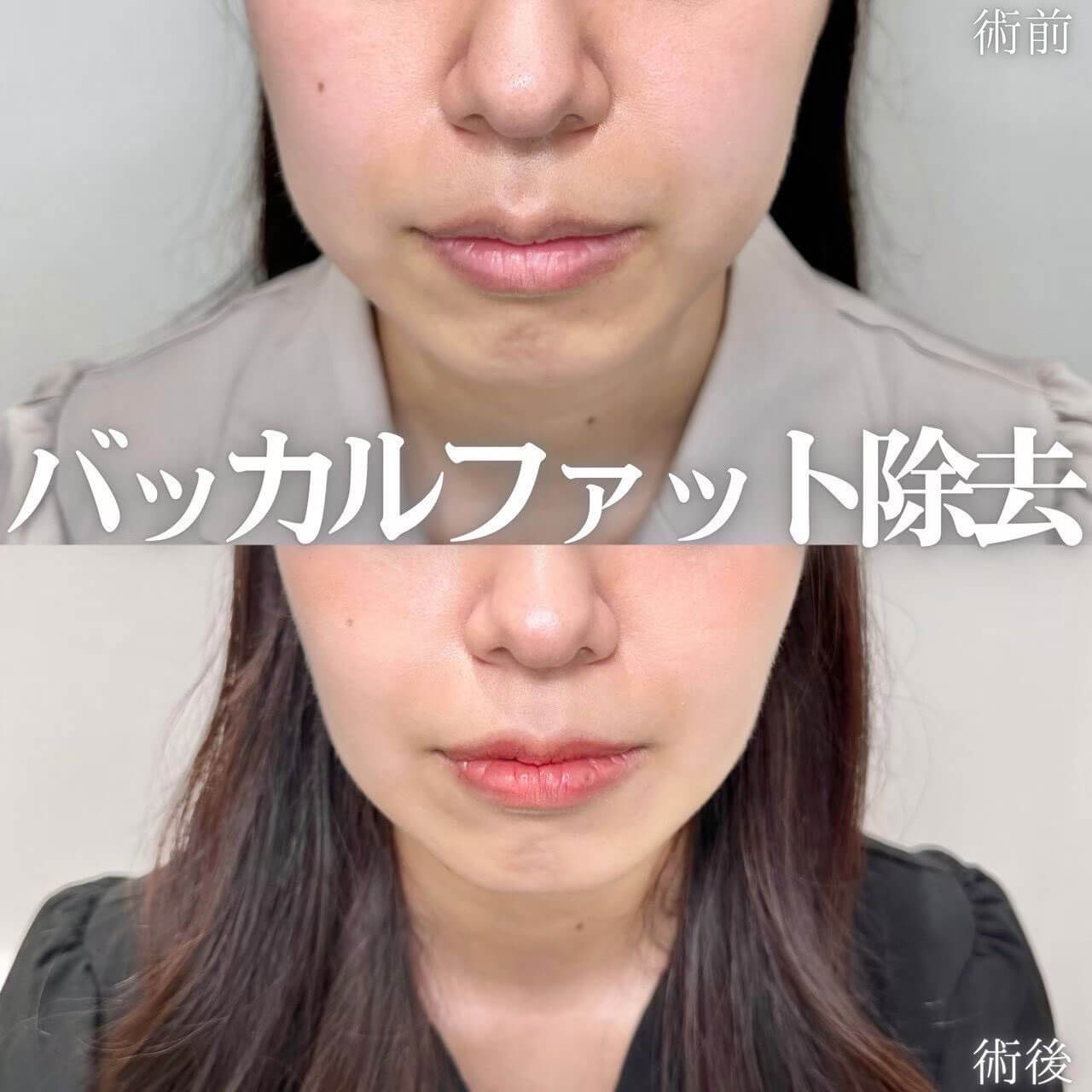 バッカルファット除去