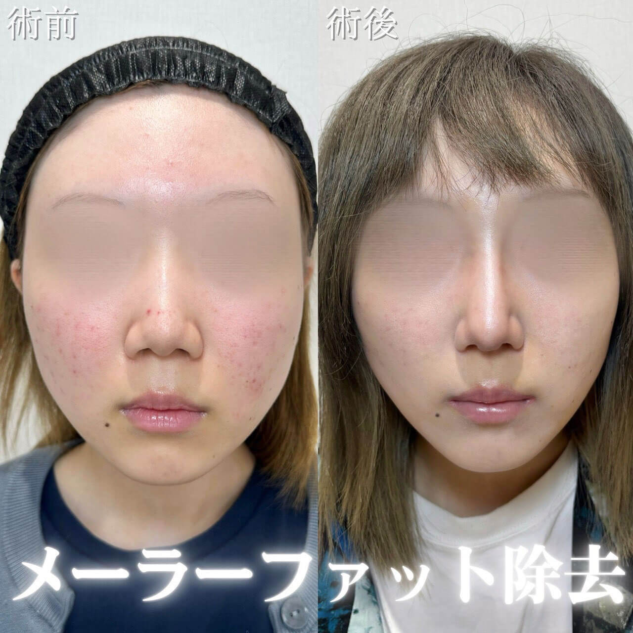 メーラーファット除去