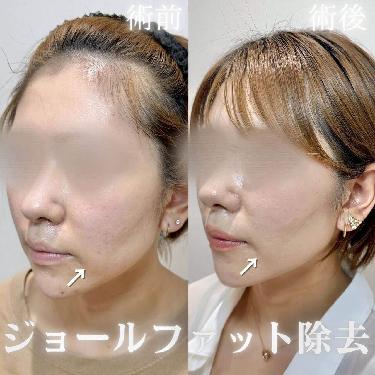 ジョールファット除去