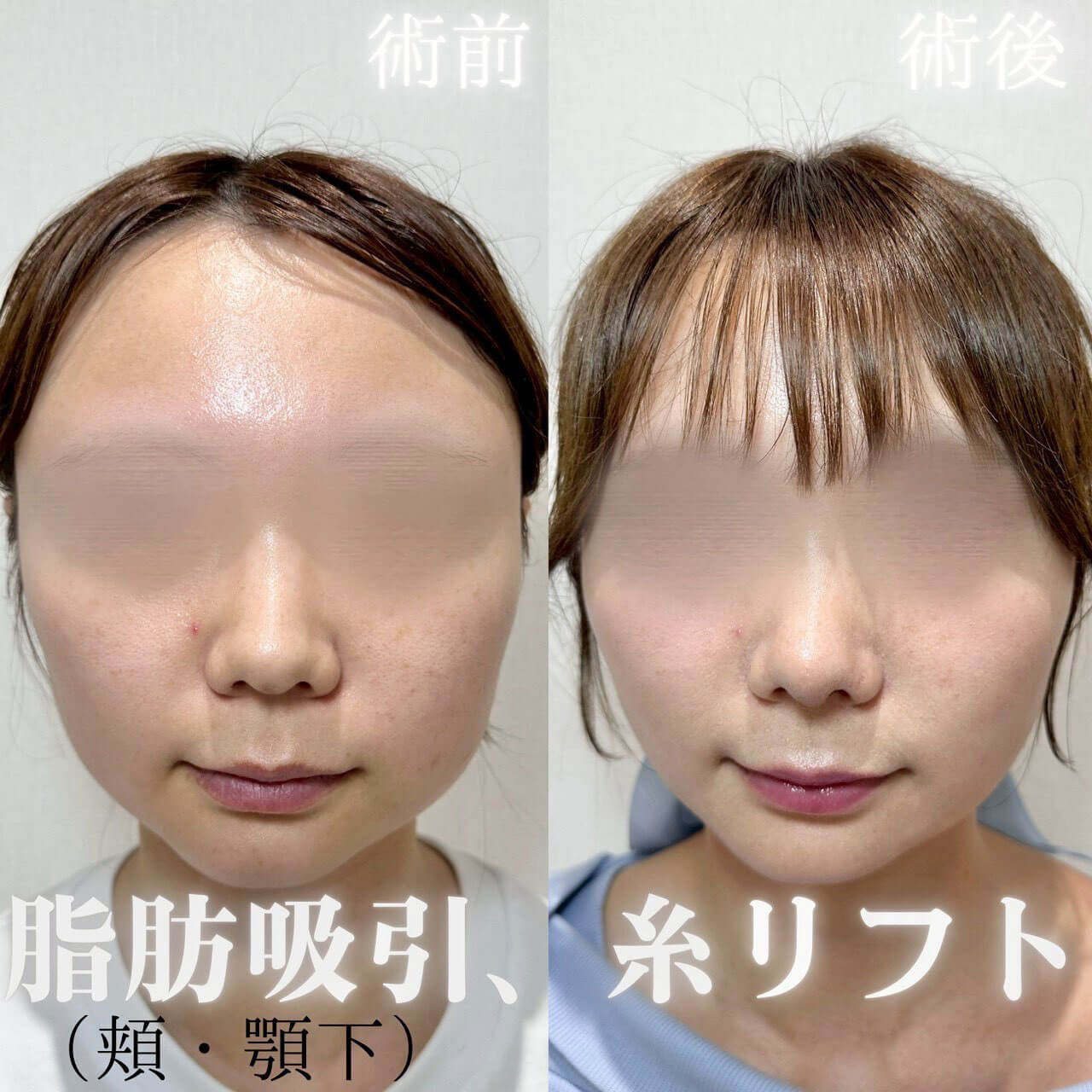 脂肪吸引(顔)+糸リフト