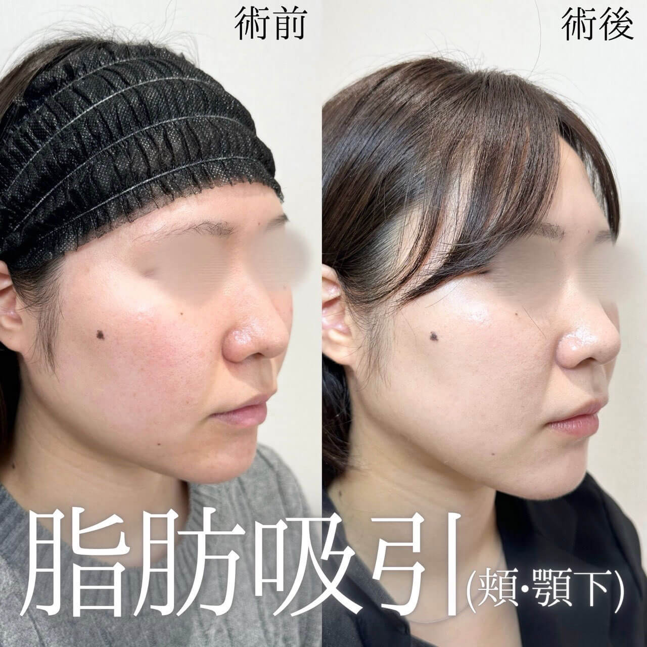 脂肪吸引(顔)+糸リフト