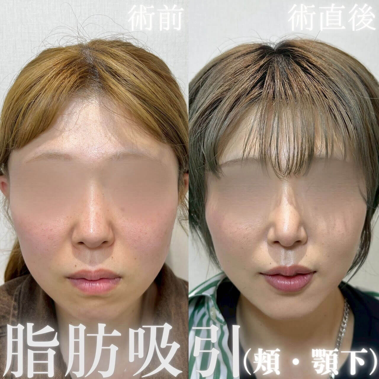 脂肪吸引(顔)+糸リフト