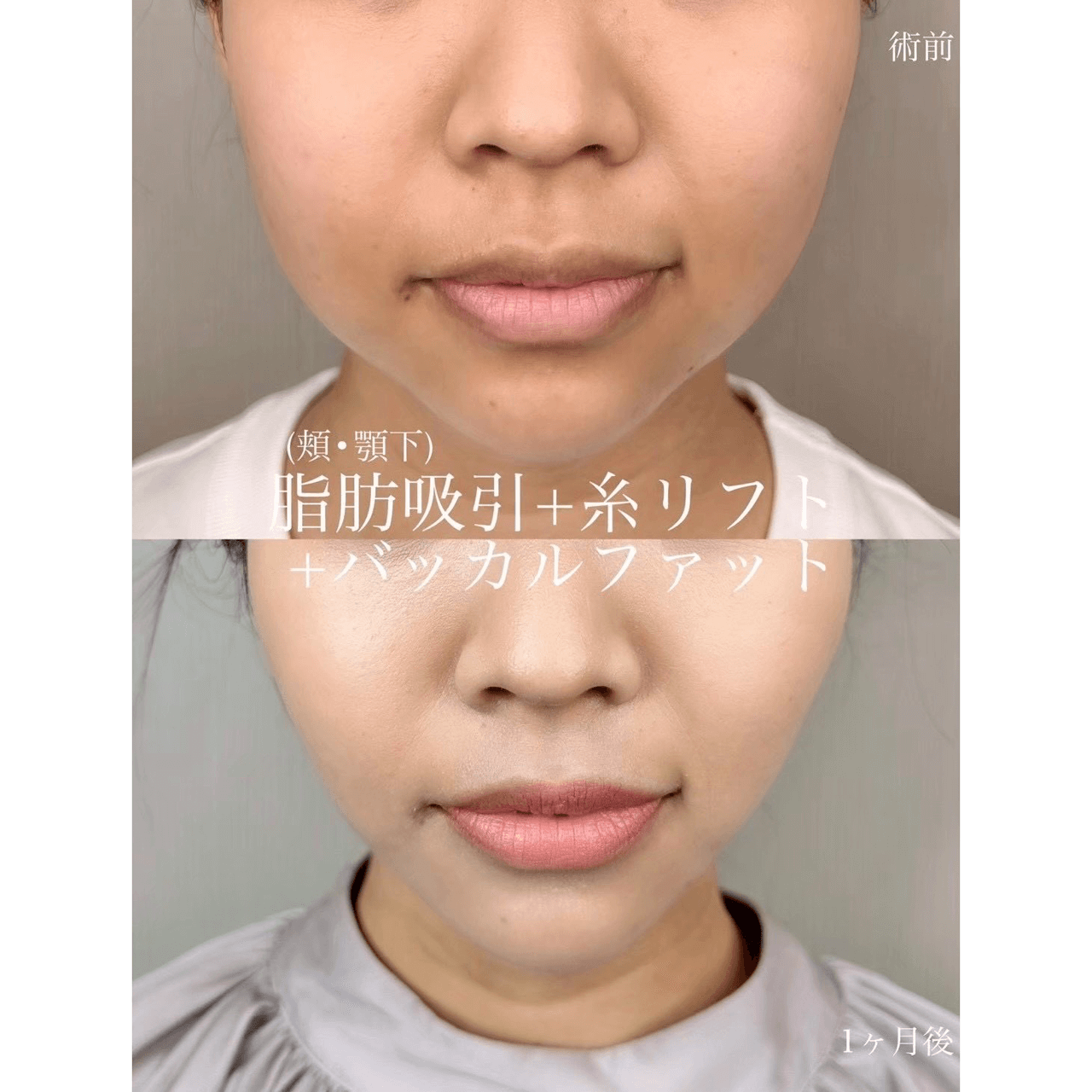 脂肪吸引(顔)+糸リフト