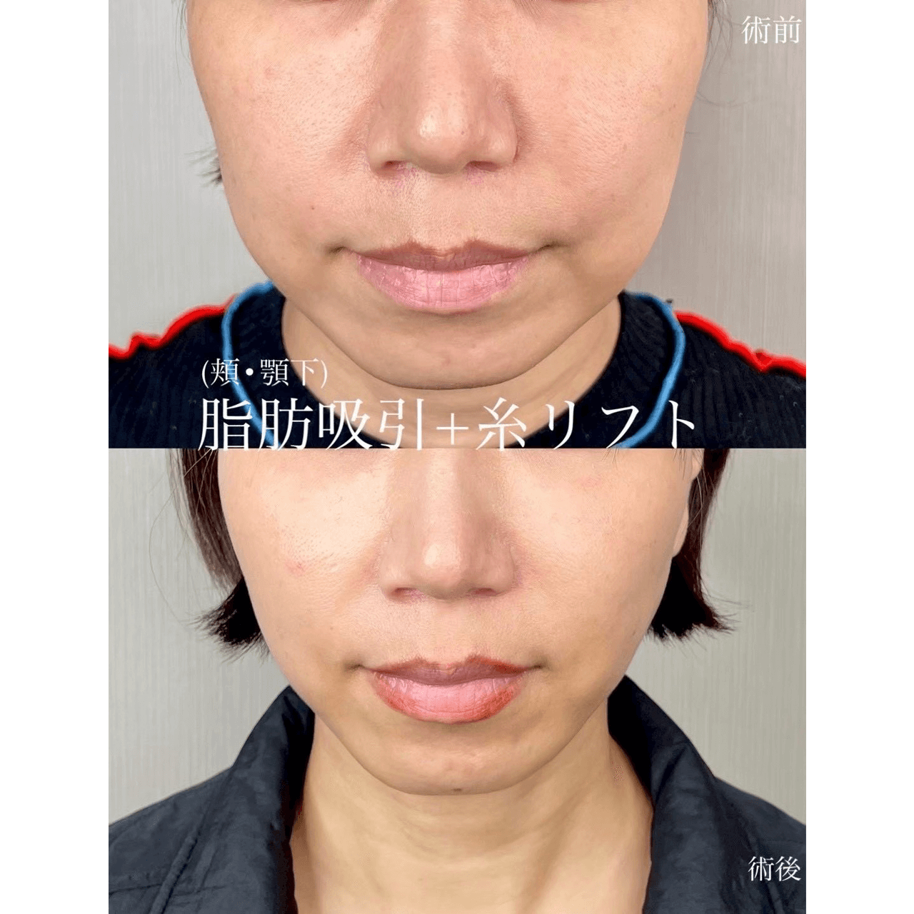 脂肪吸引(顔)+糸リフト