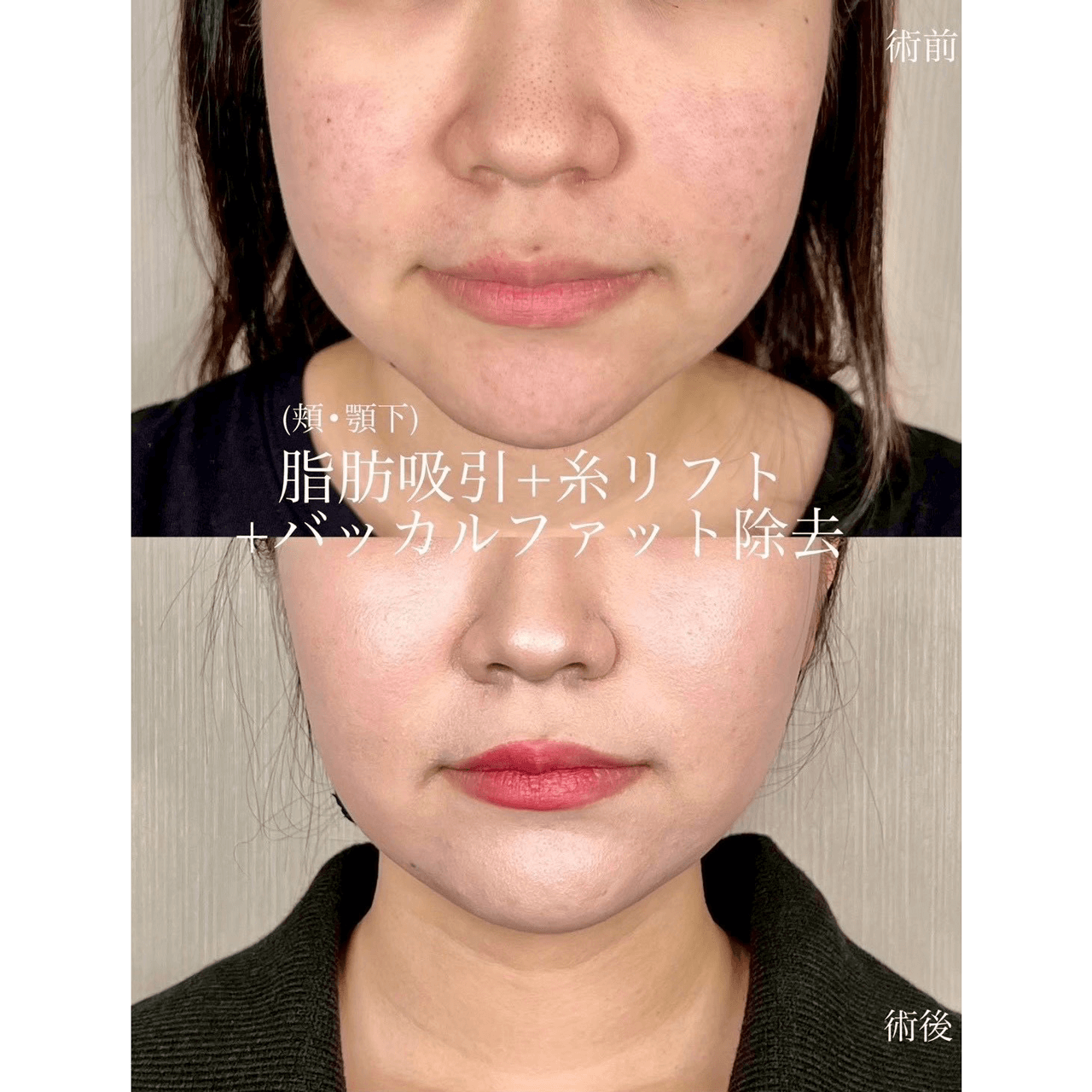 脂肪吸引(顔)+糸リフト