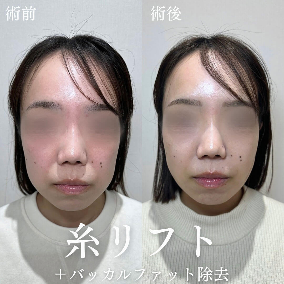 小顔 症例11