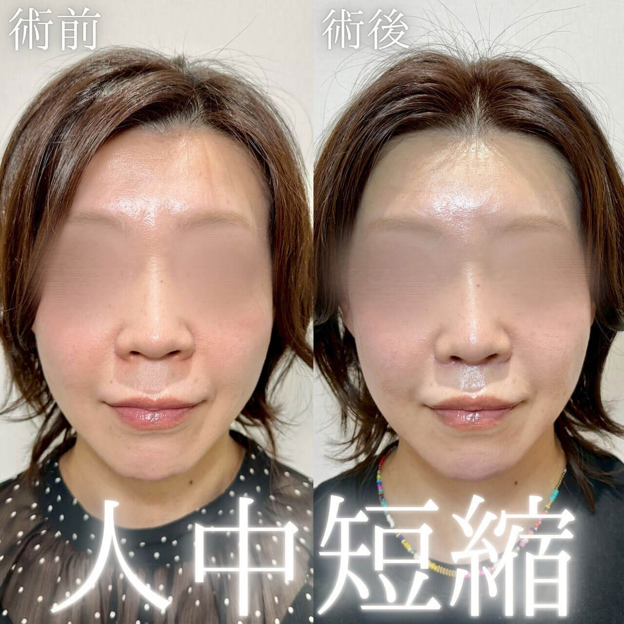 人中短縮 症例09