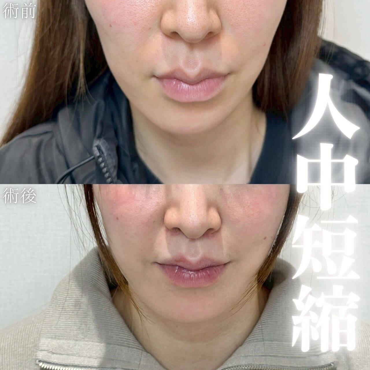 人中短縮 症例10