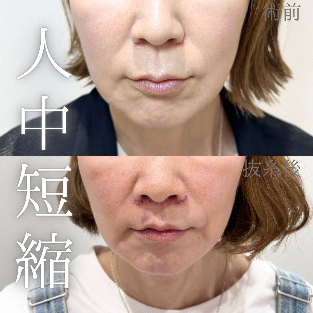 人中短縮 症例11