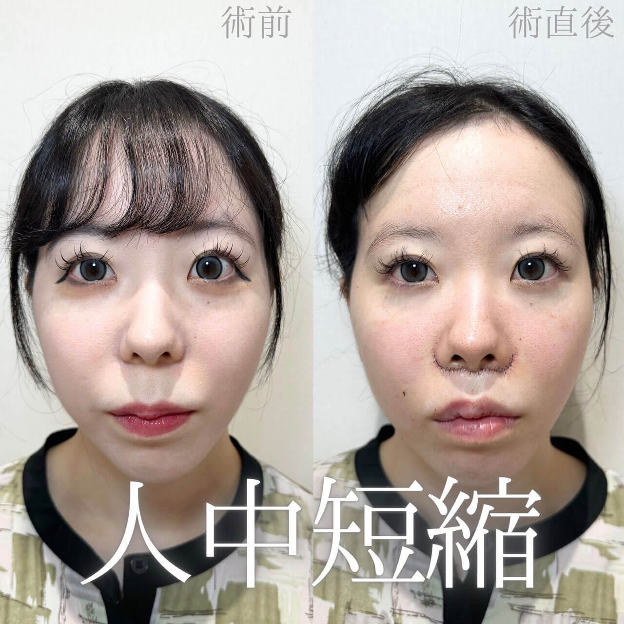 人中短縮 症例12