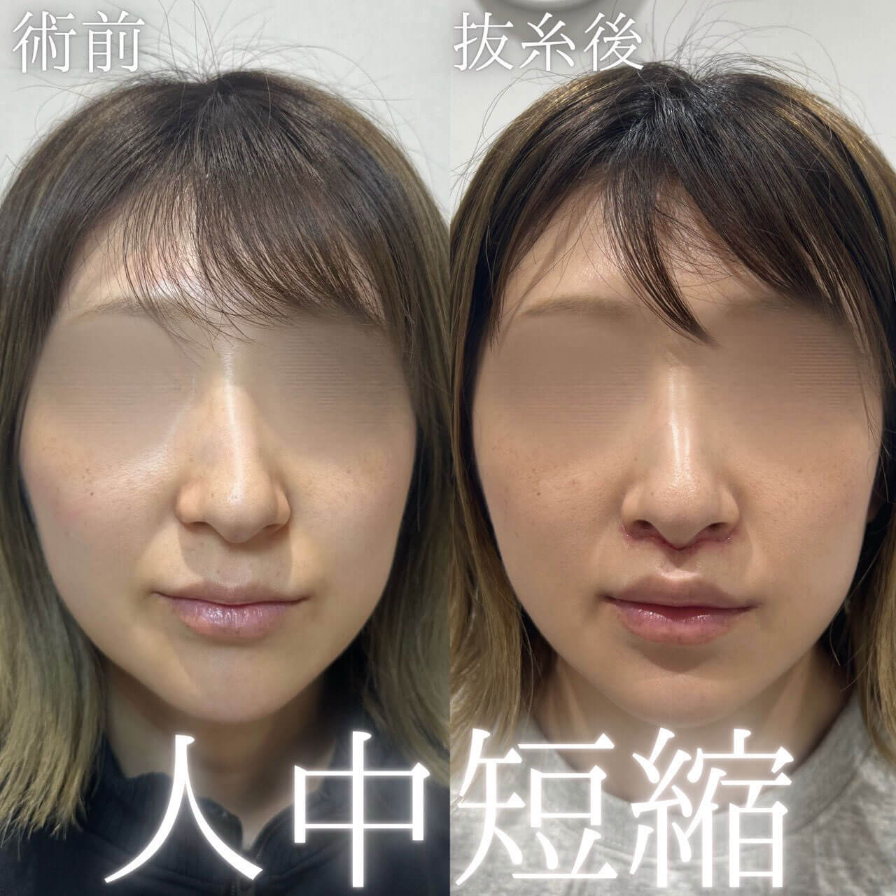 人中短縮 症例13