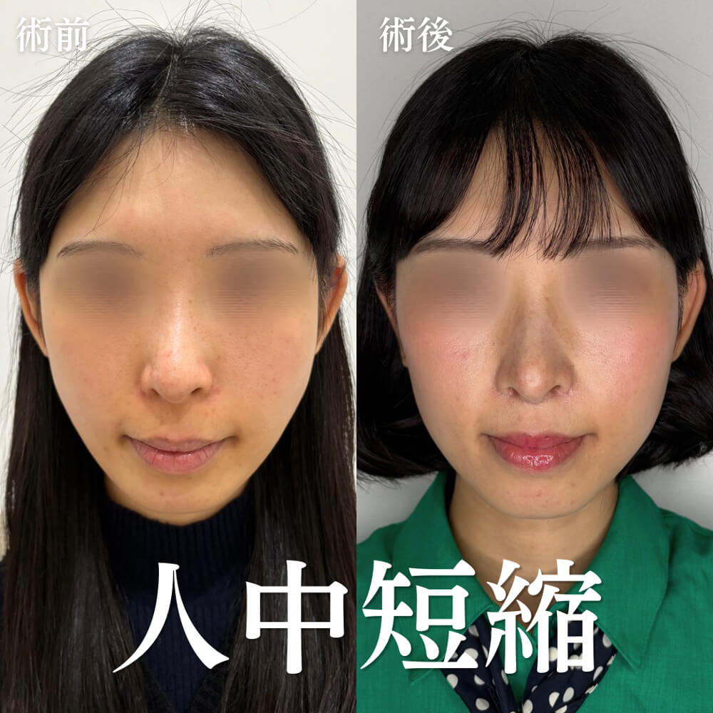人中短縮 症例14