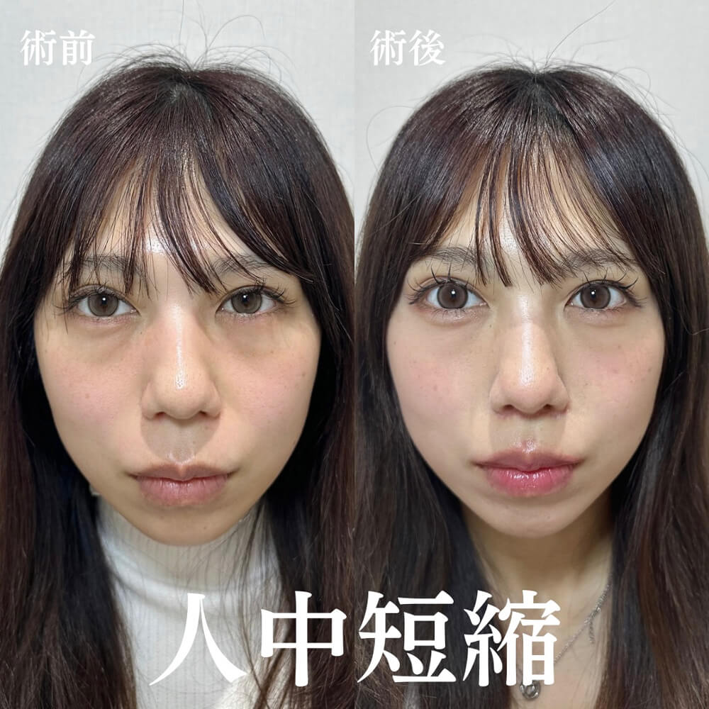 人中短縮 症例15