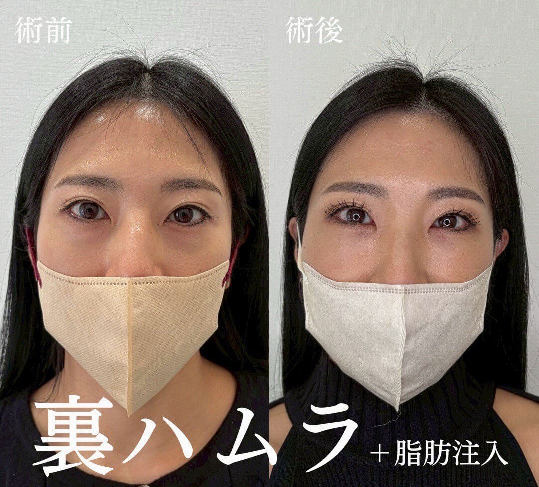 ハムラ法 症例01