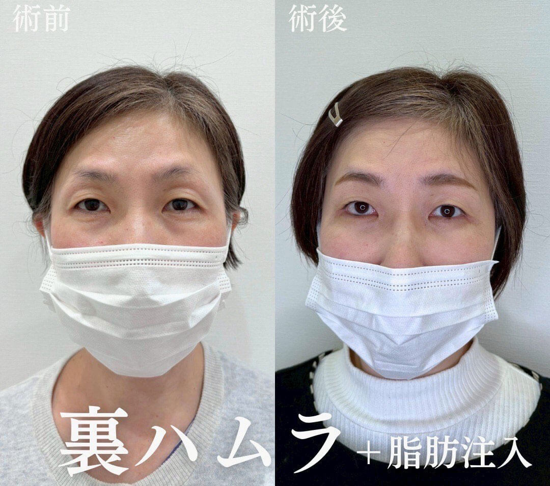 ハムラ法 症例02