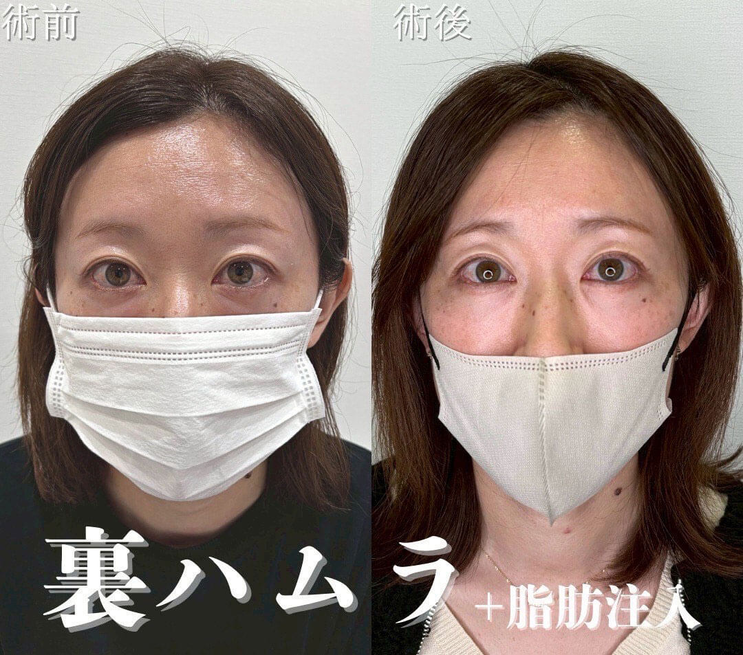 ハムラ法 症例03