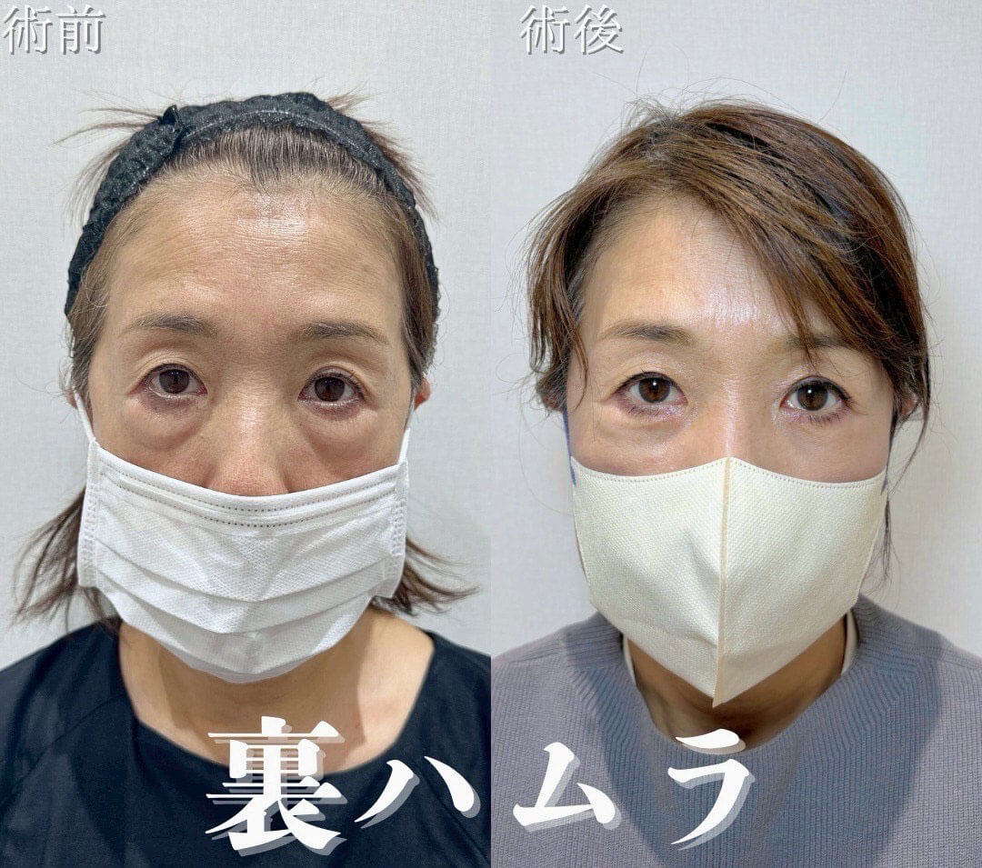 ハムラ法 症例04