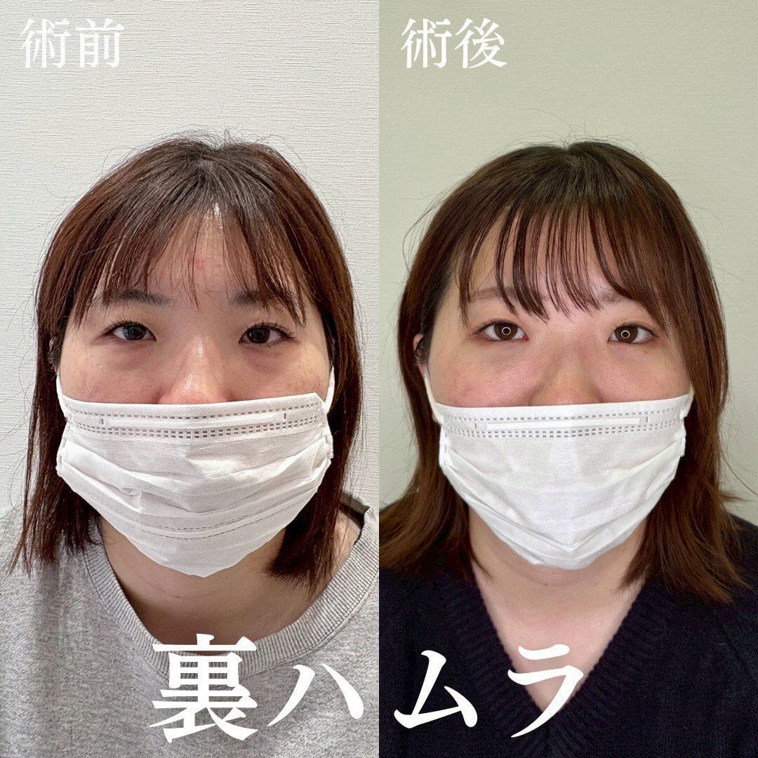 ハムラ法 症例06