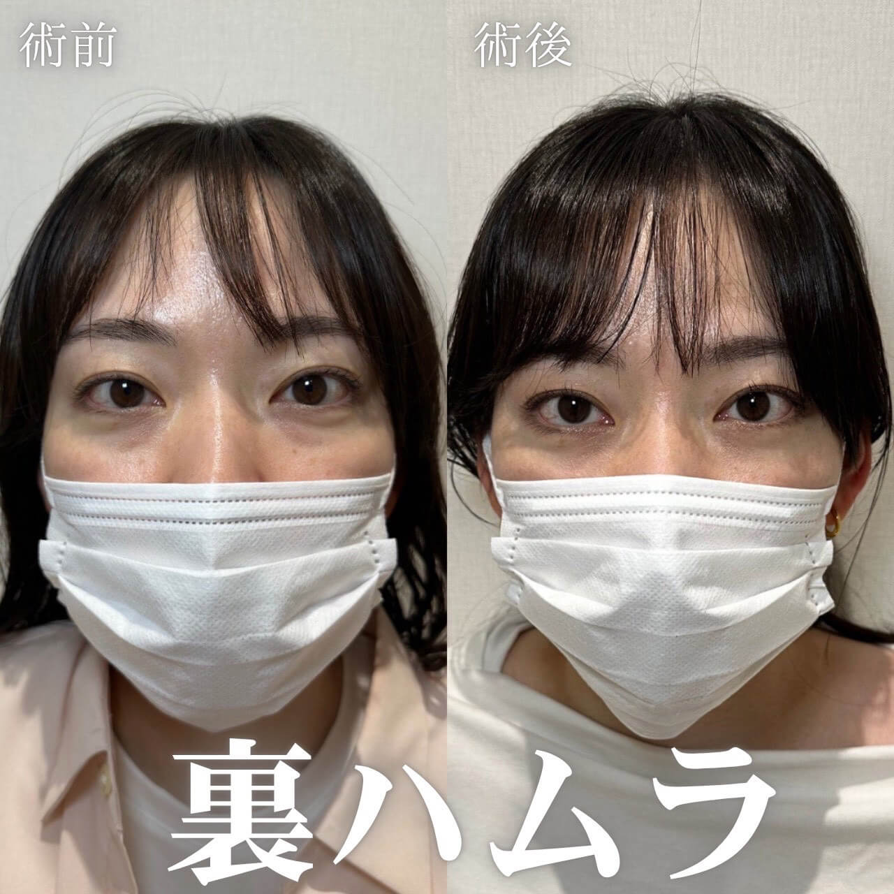 ハムラ法 症例09