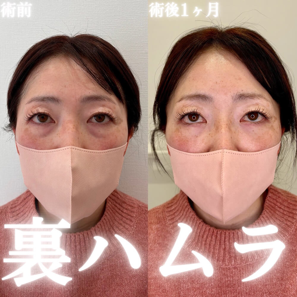 ハムラ法 症例12