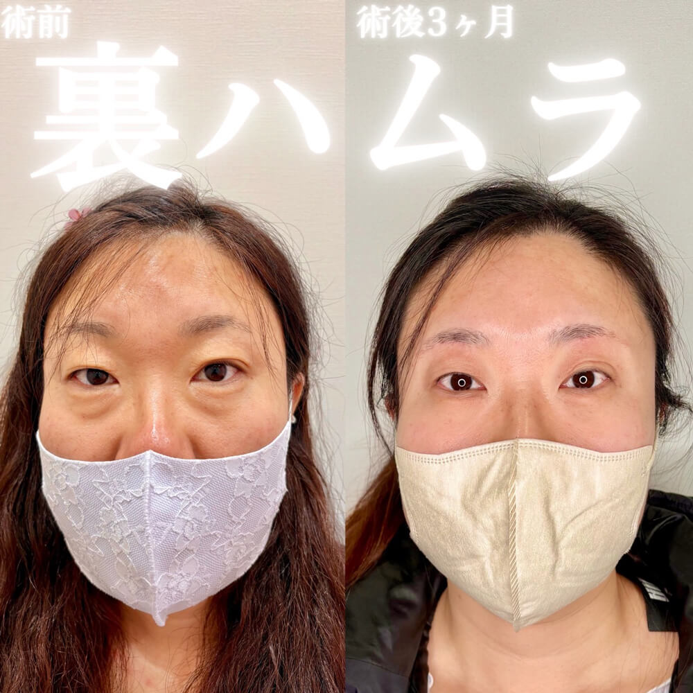 ハムラ法 症例13