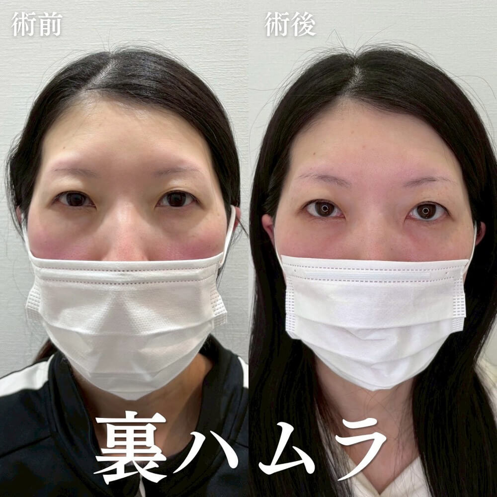 ハムラ法 症例14