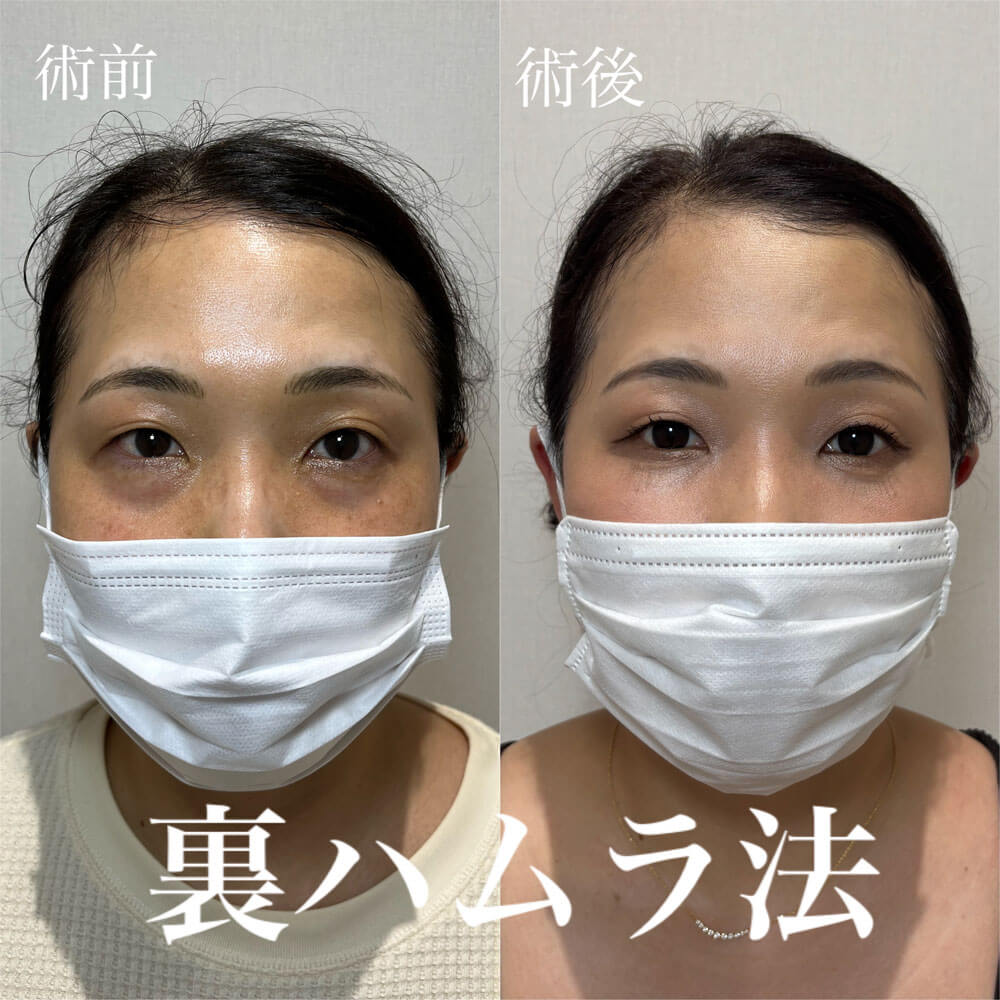 ハムラ法 症例14