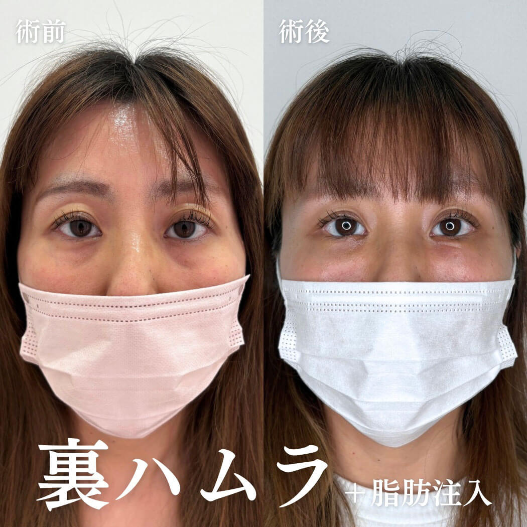 ハムラ法 症例15