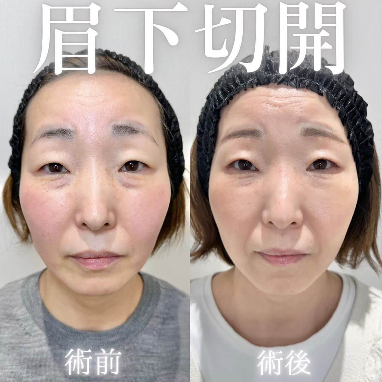 眉下切開 症例01