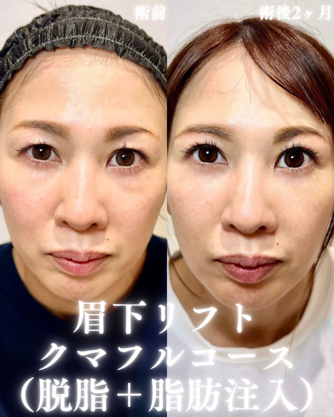 眉下切開 症例02