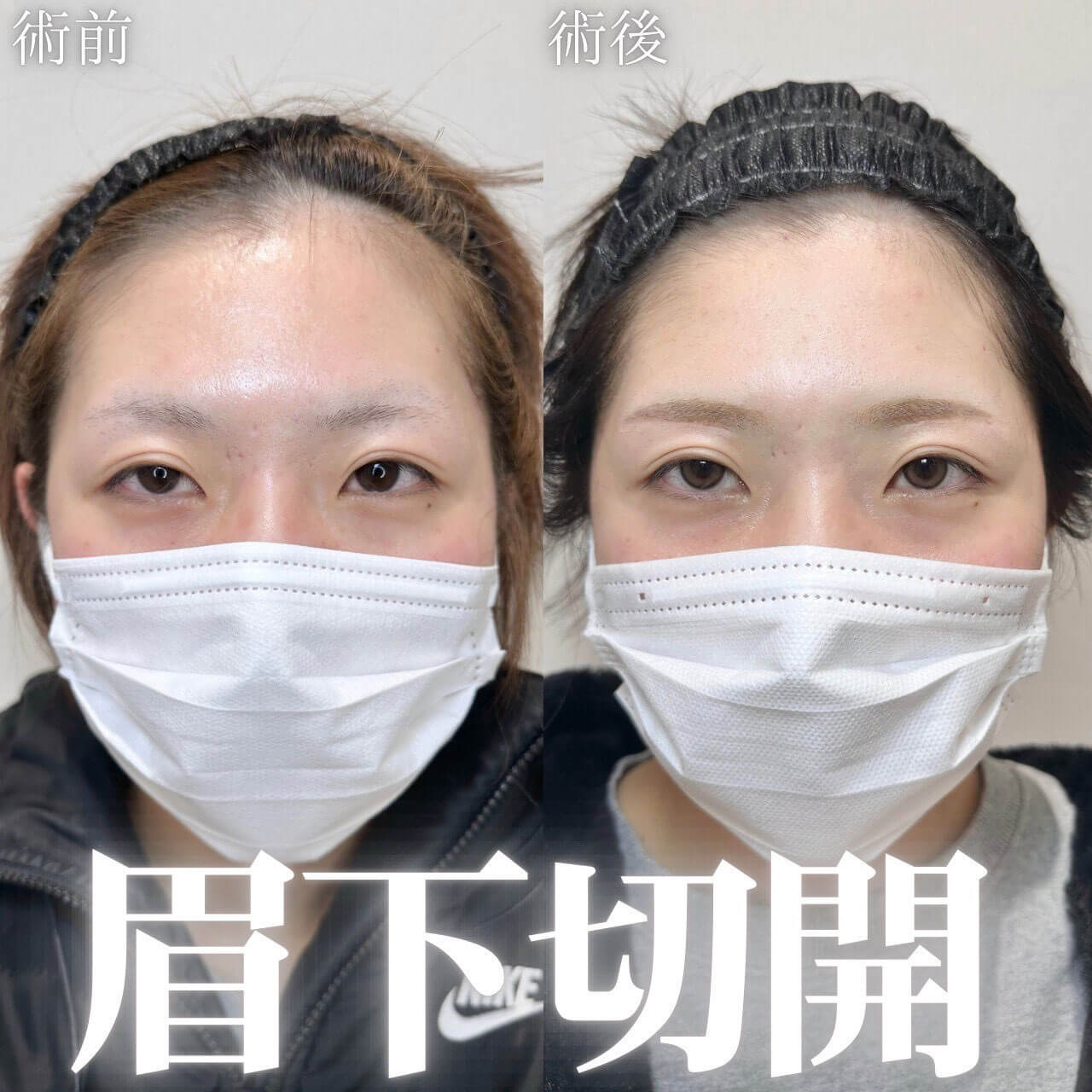 眉下切開 症例03