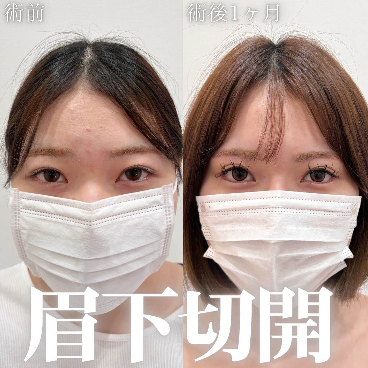 眉下切開 症例04