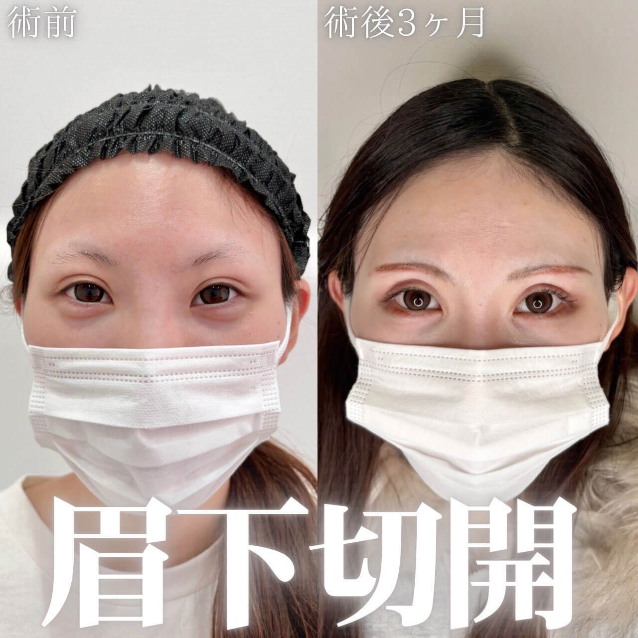 眉下切開 症例05