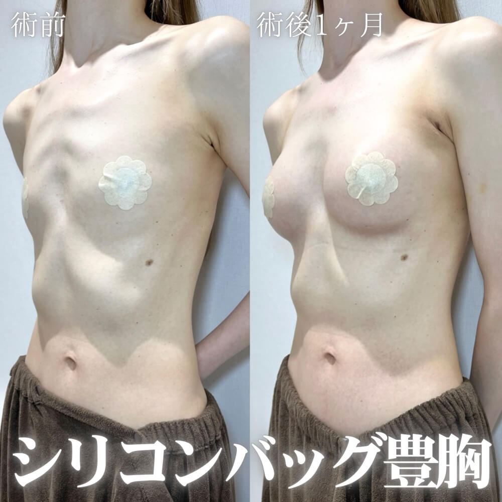 豊胸 症例06