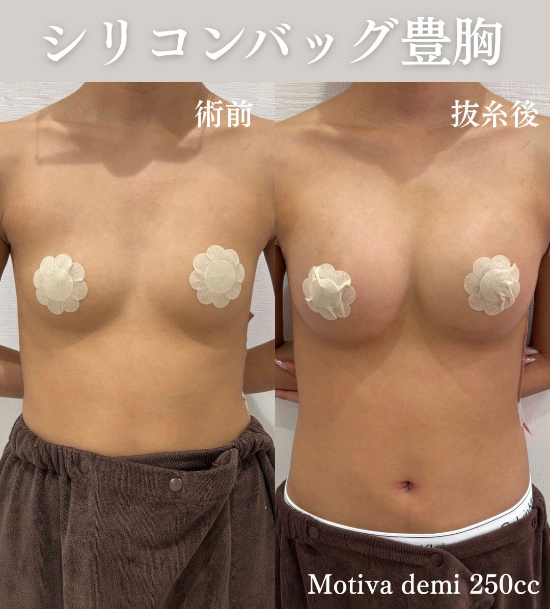 豊胸 症例09