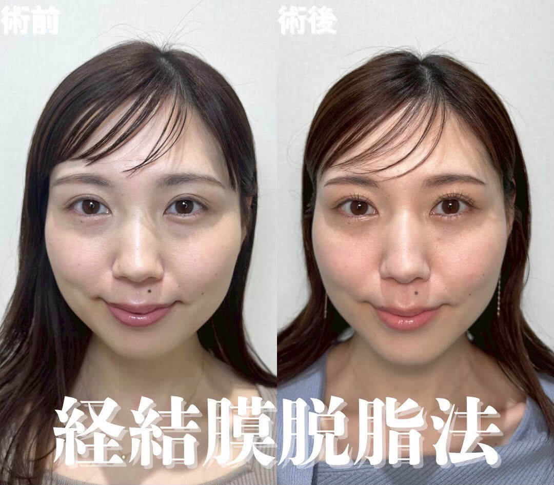 経結膜脱脂の症例
