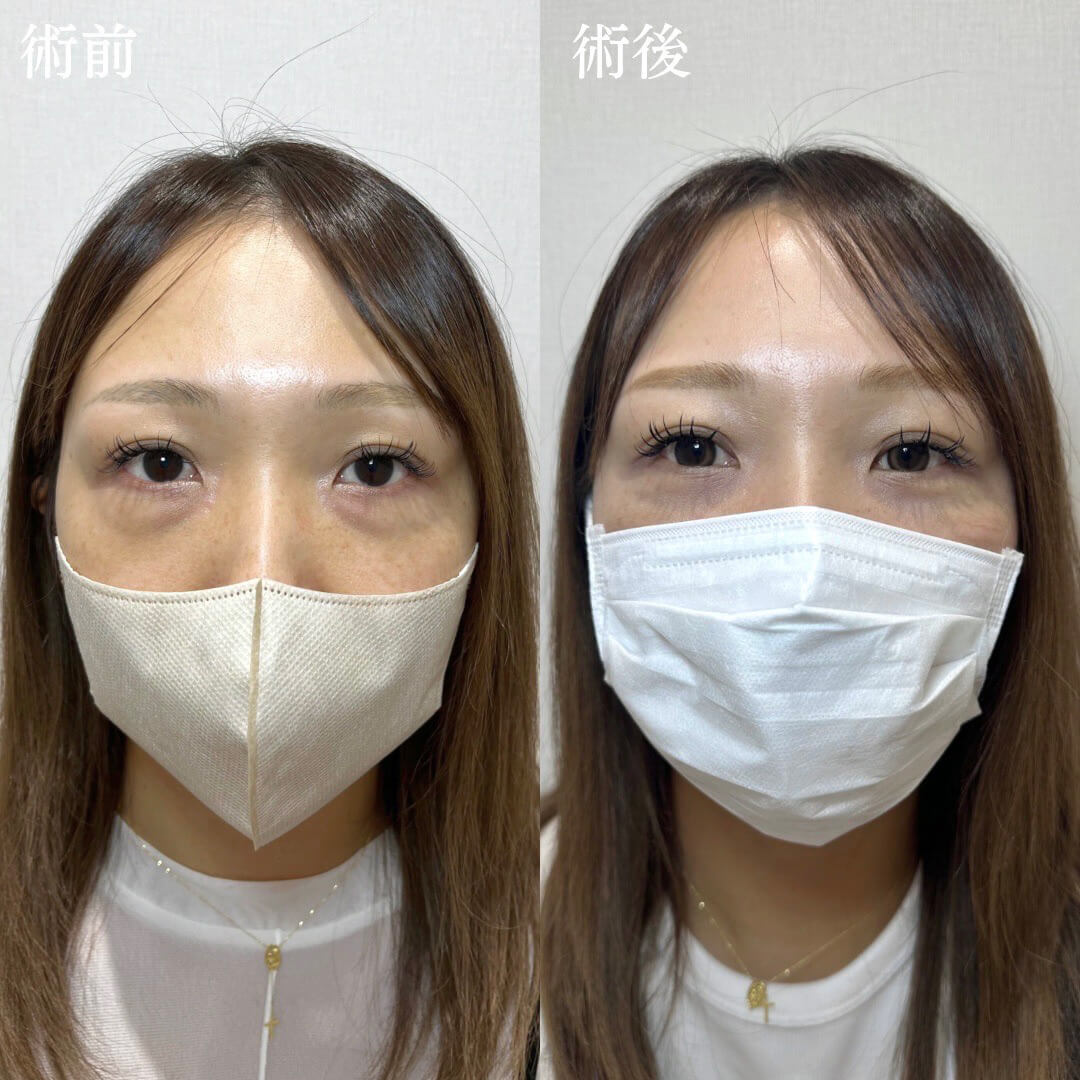 経結膜脱脂の症例