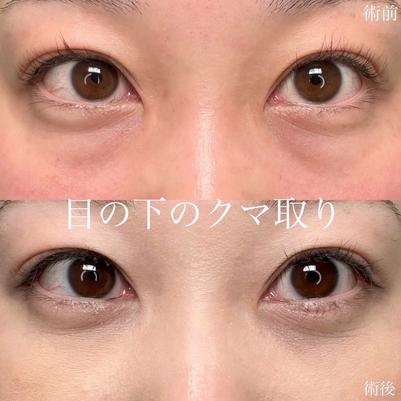 経結膜脱脂の症例