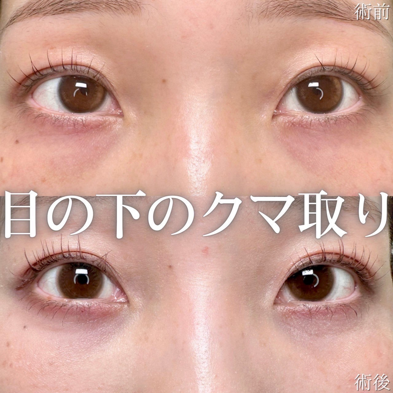 経結膜脱脂の症例