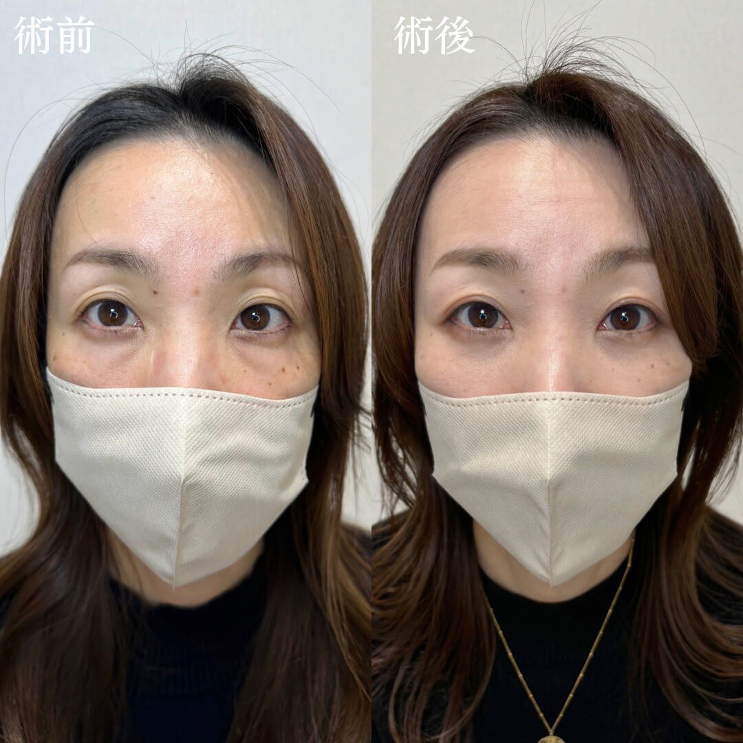 経結膜脱脂の症例