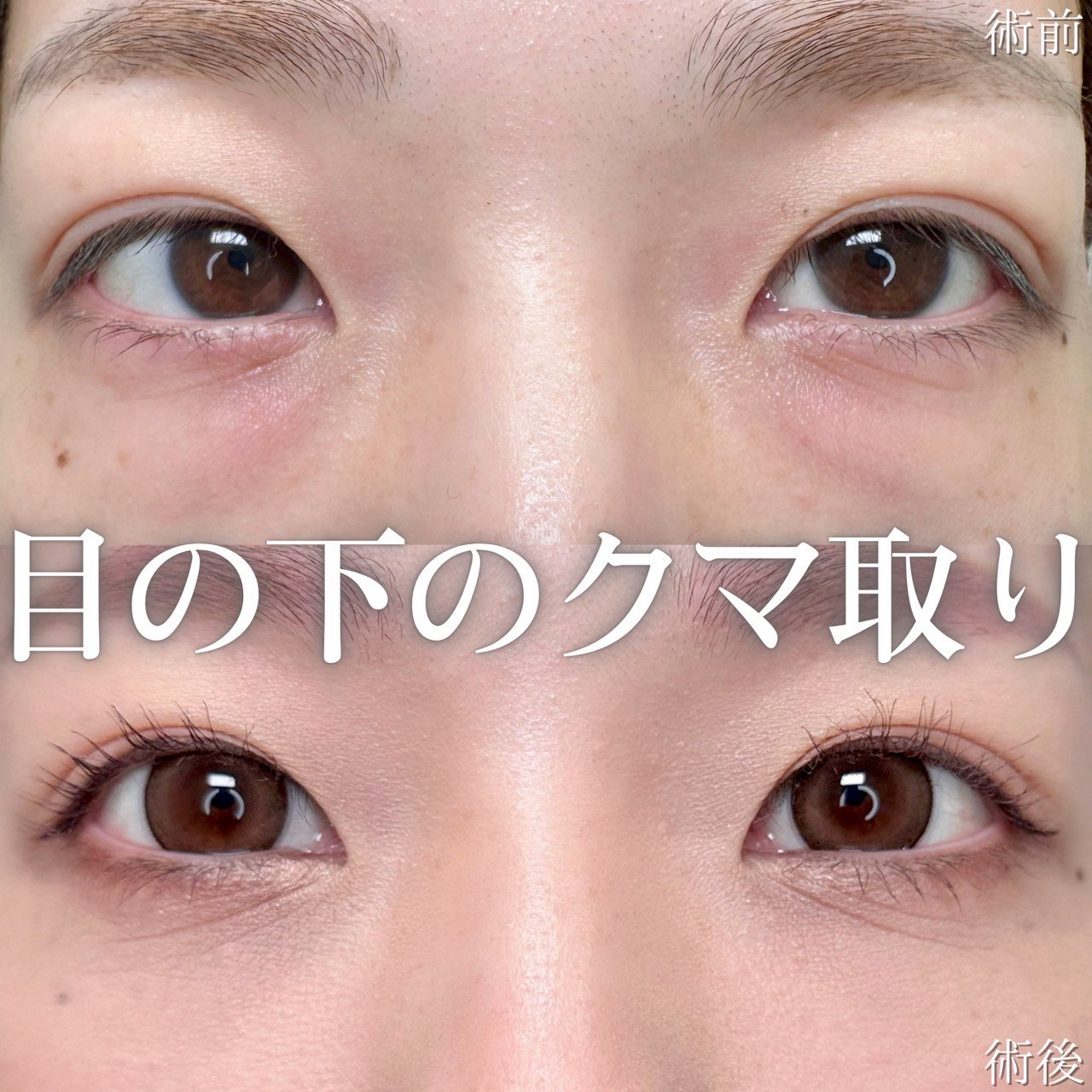 経結膜脱脂の症例