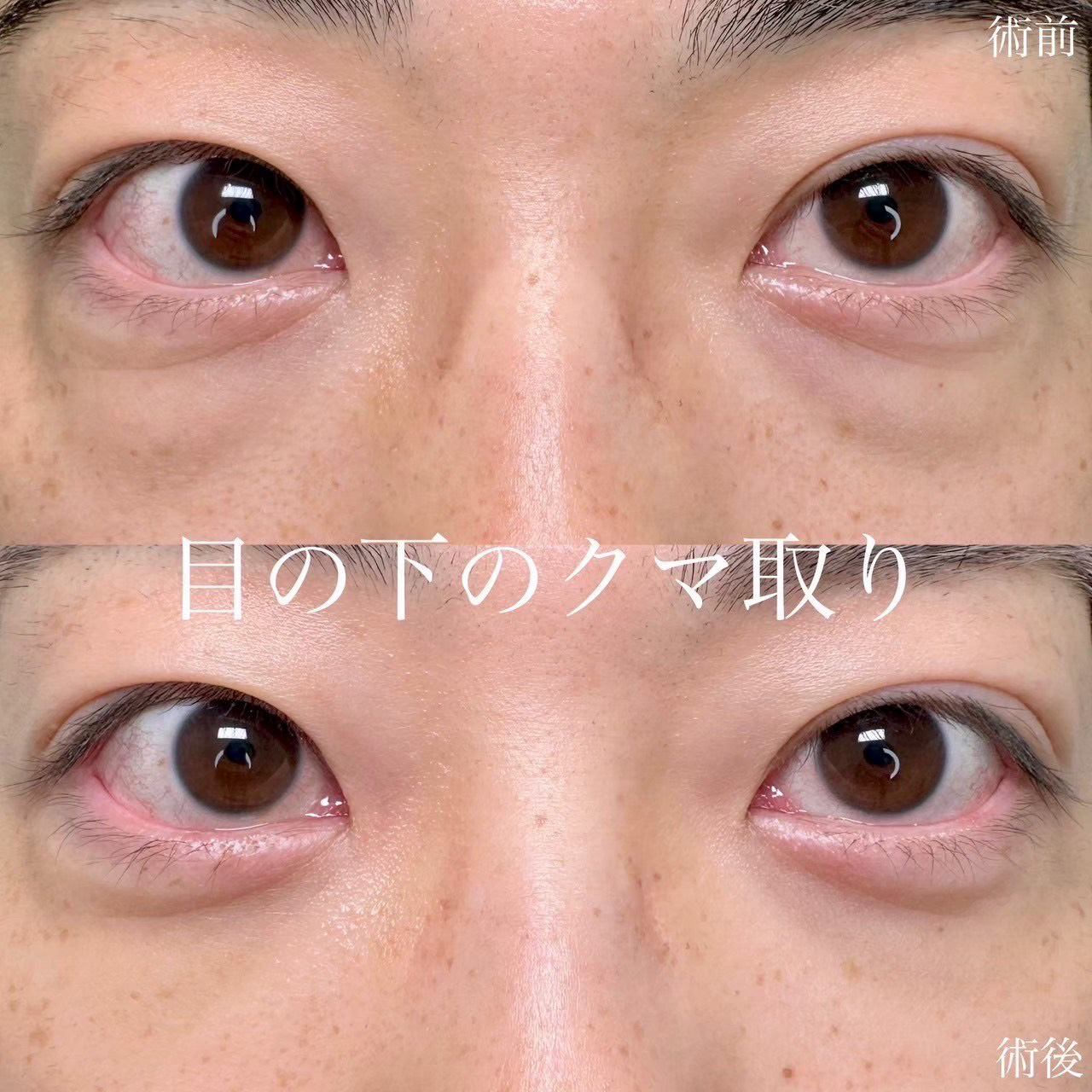 経結膜脱脂の症例