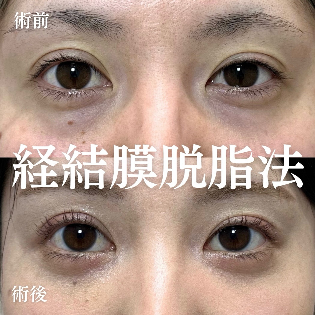 経結膜脱脂の症例