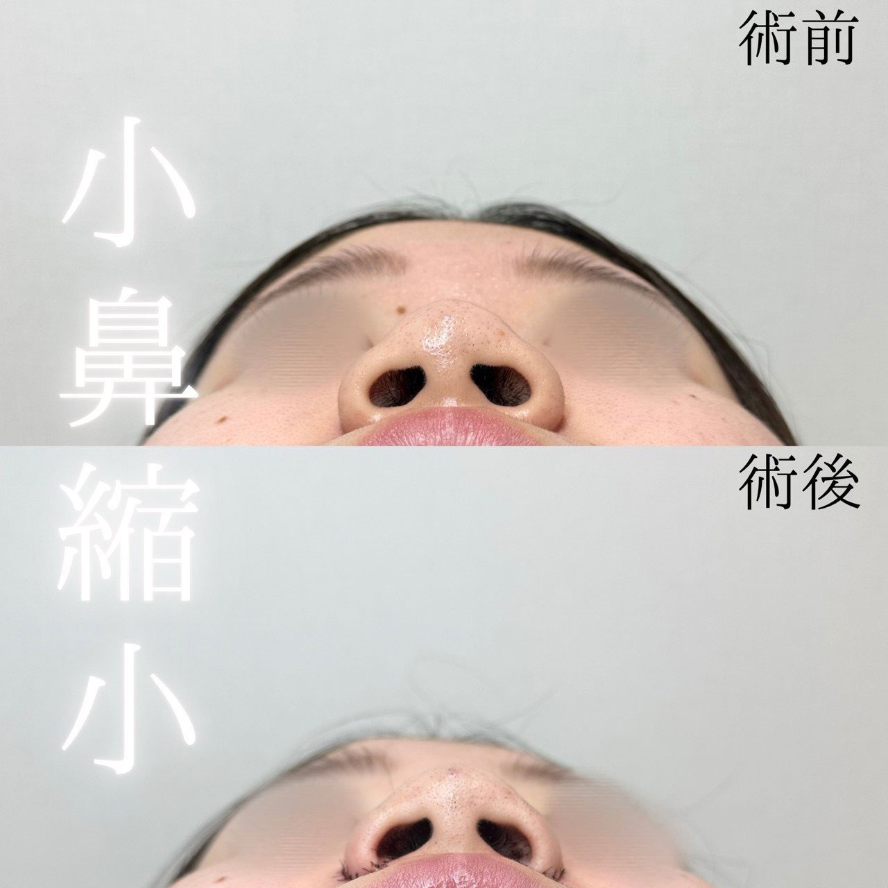 小鼻縮小内外側法の症例