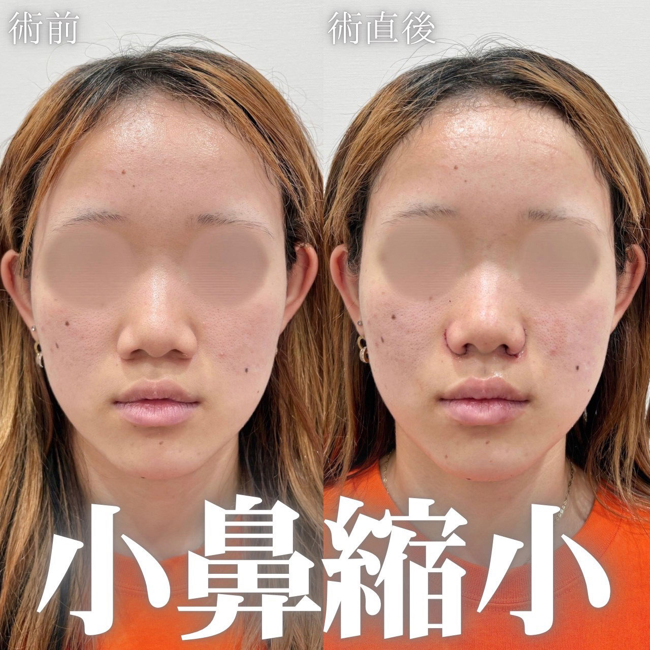 小鼻縮小内外側法の症例
