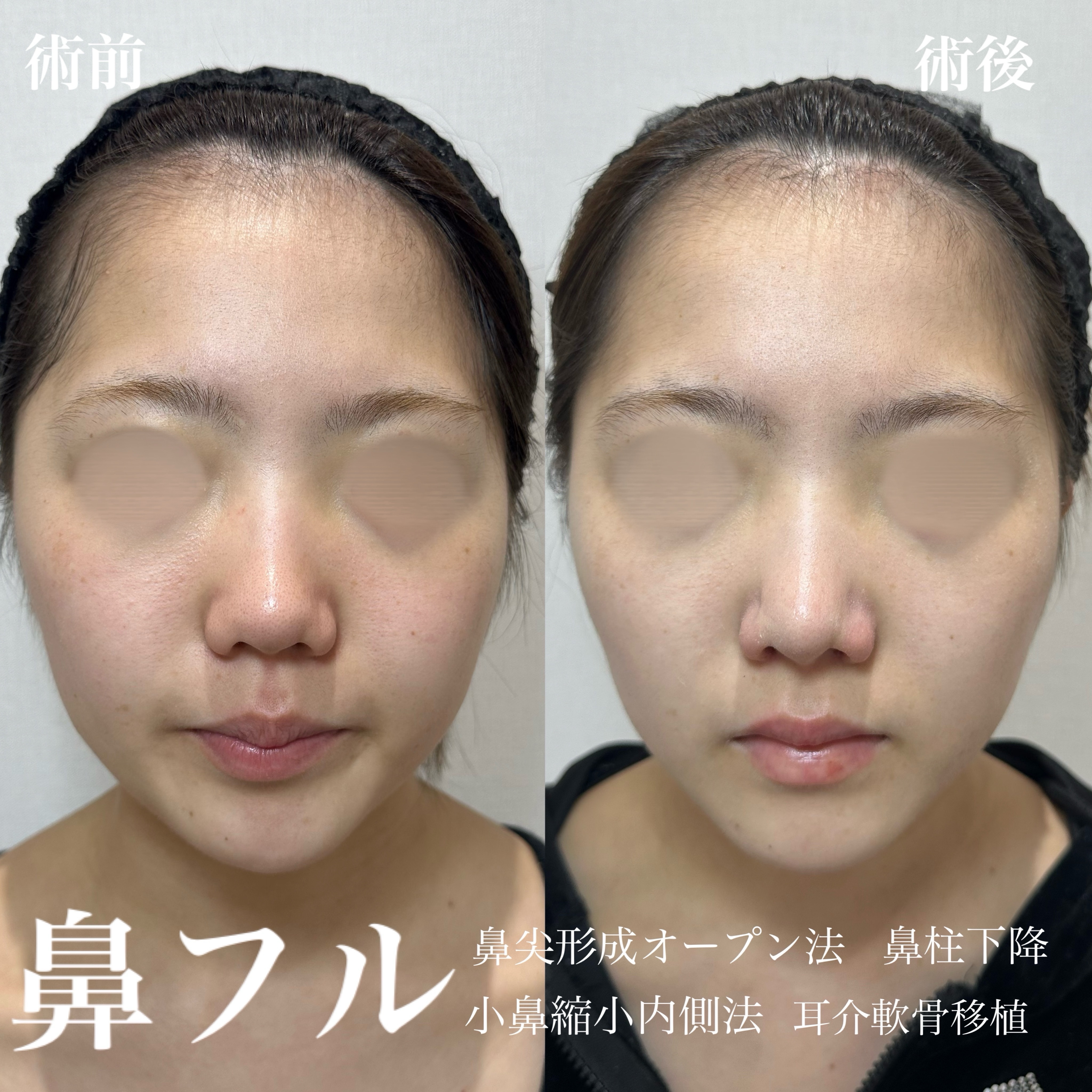 鼻尖形成(オープン法)+耳介軟骨移植+小鼻縮小(内外側法)+鼻柱下降の症例