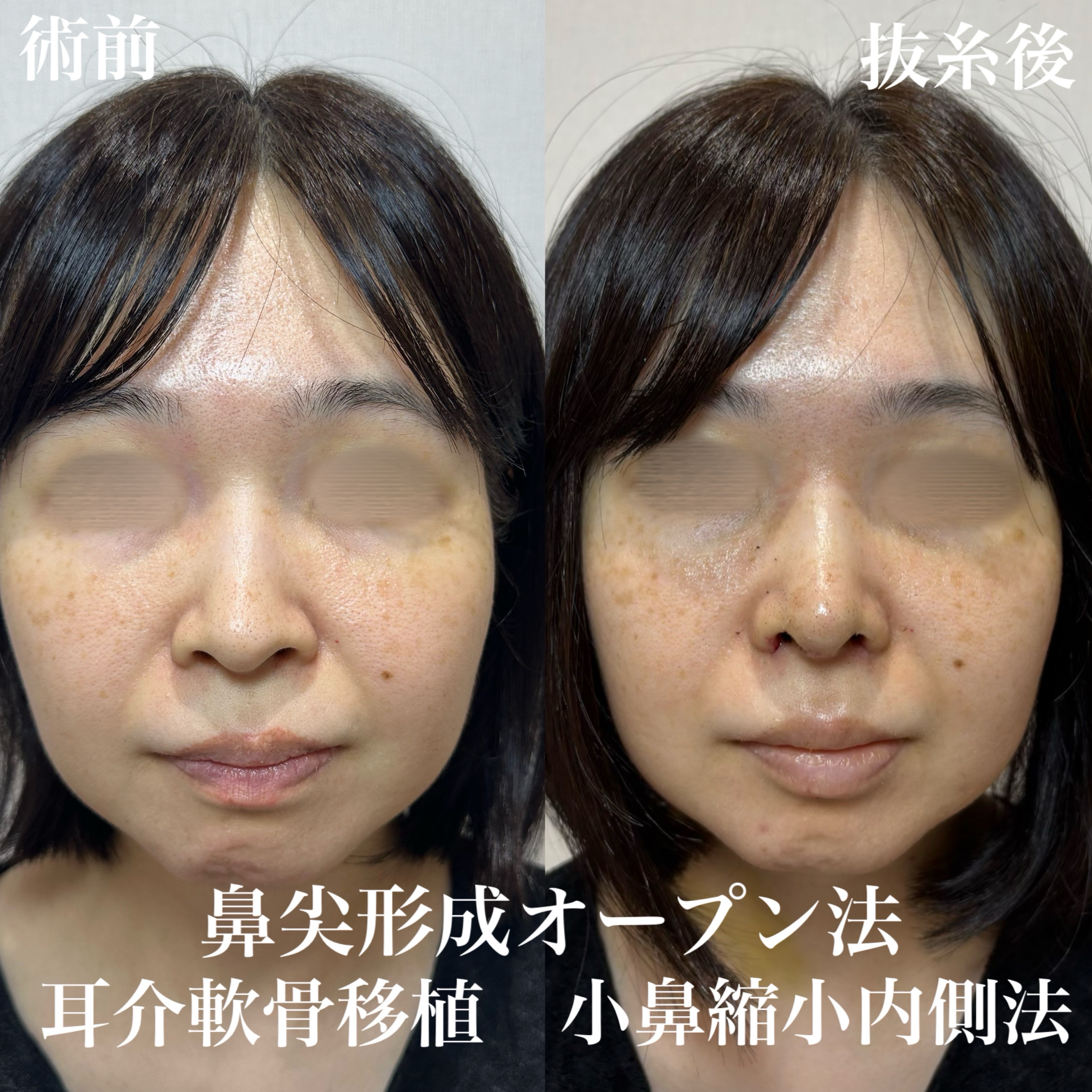 鼻尖形成(オープン法)+耳介軟骨移植+小鼻縮小(内側法)の症例